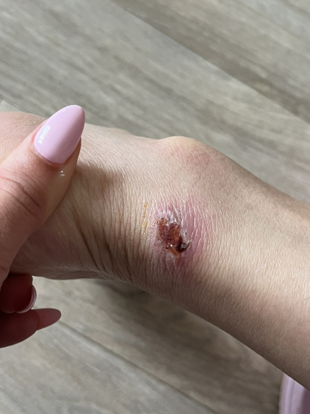 Should I leave it or get medical help? *warning, pics*