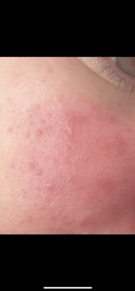 Does this look like rosacea?