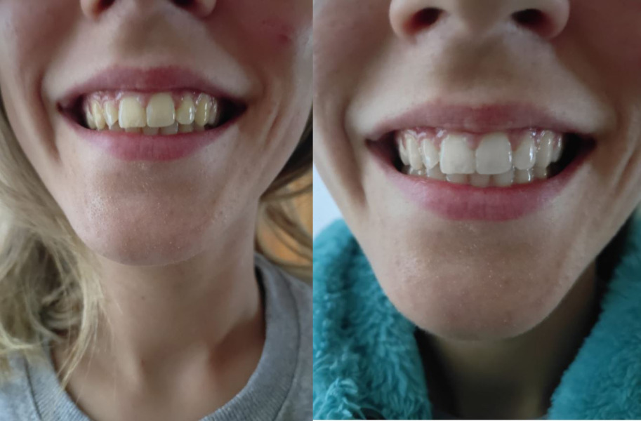Teeth whitening 