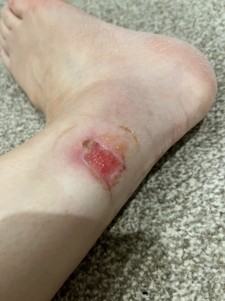 Can anyone advise on wound care? (Picture)