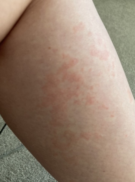 What could this rash be?
