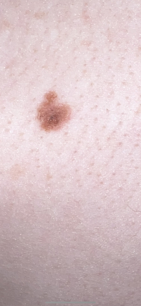Melanoma what next?
