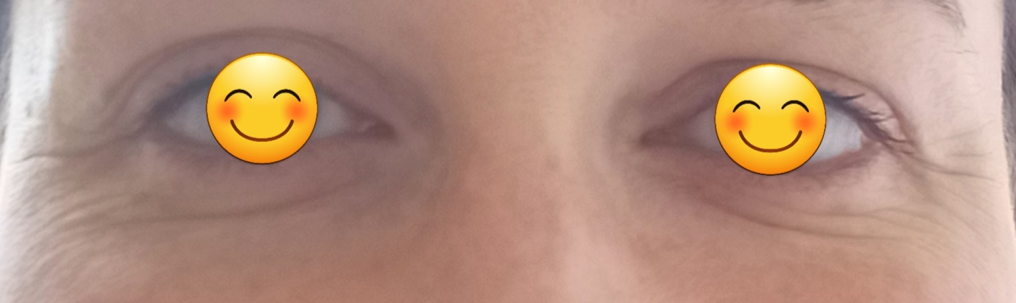 Eye wrinkles