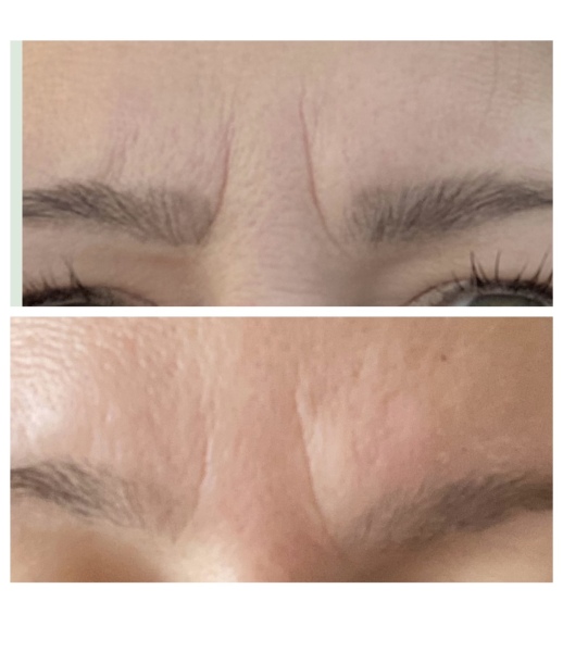 Too skint for Botox? I’m using stickers that seem to be working!