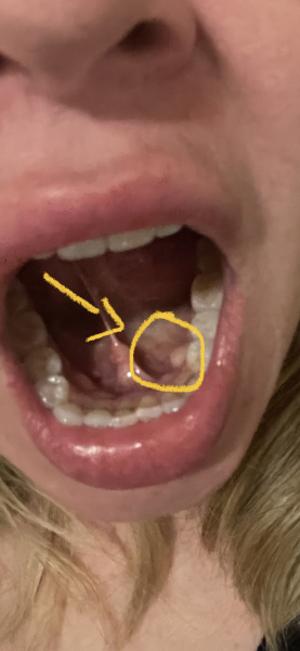 Any dentists/ hygienists? What’s this lump? 