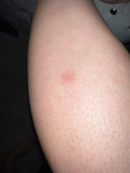 Red itchy lump