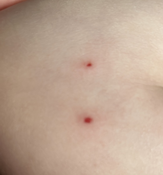 To ask what bite this could be?