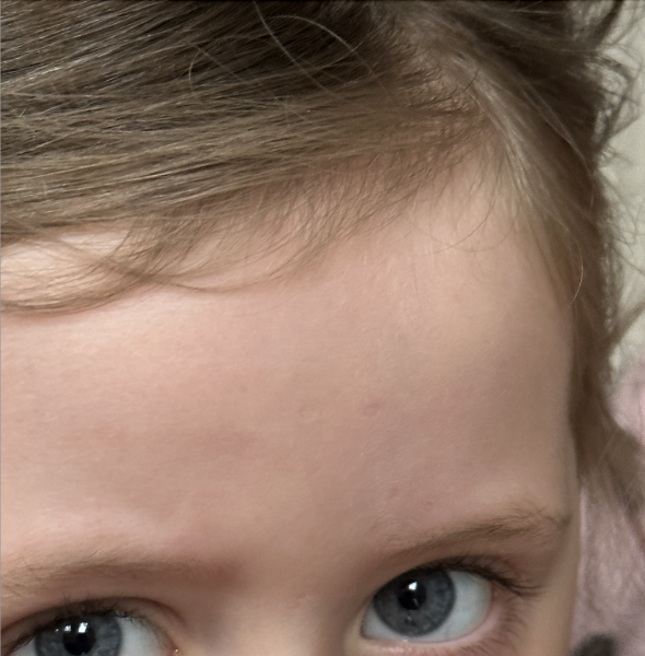 Severe chicken pox help!