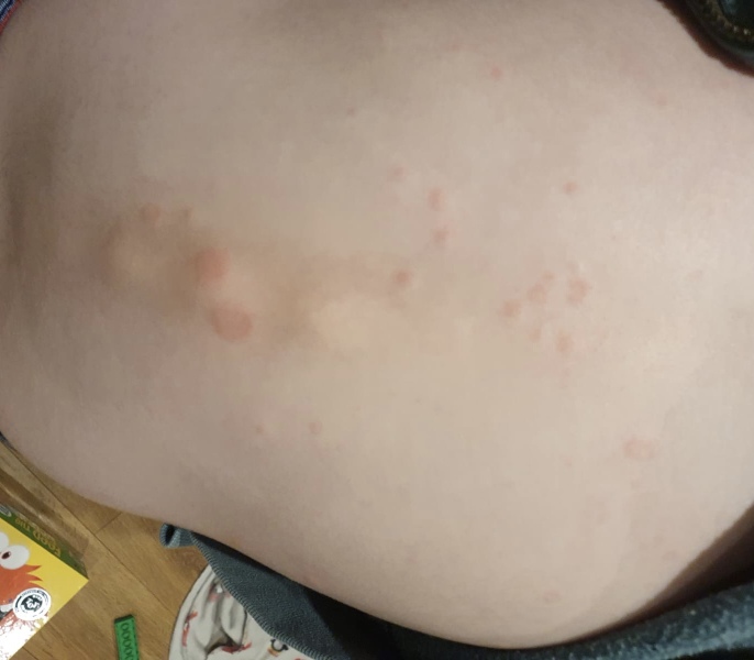 What is this rash