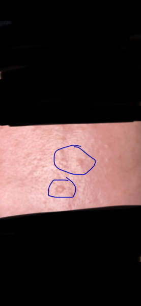 What are these bumps on my forehead?