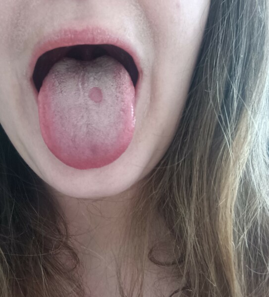 Psoriasis -advice before GP appointment 