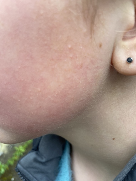 Is this rosacea on my 12yo DD's face?
