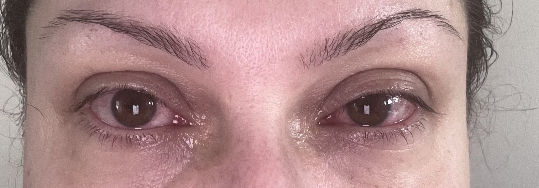 Severe Tonsillitis / sinusitis and conjunctivitis 