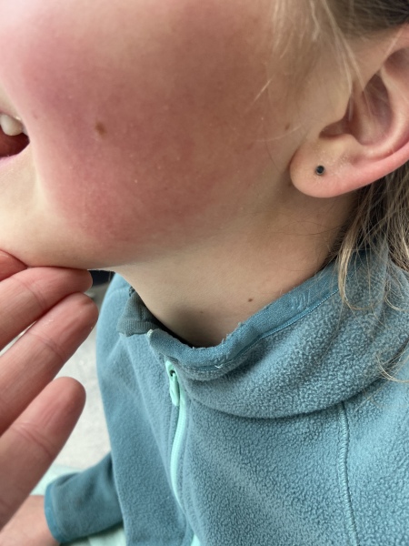 Red cheeks- 11 year old DD