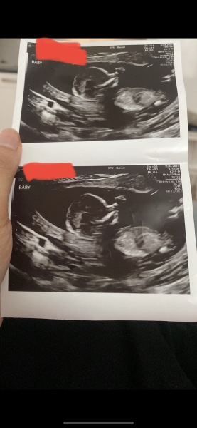 14 week scan! Boy or girl?
