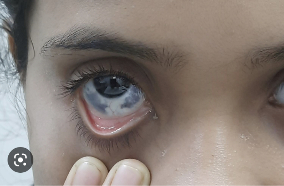 Dark patches in mixed infants eye