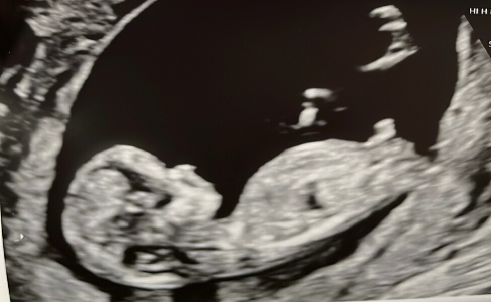 Nub theory - please guess my baby's gender!