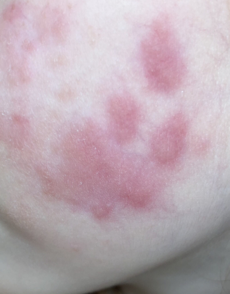 What is this rash? Pic