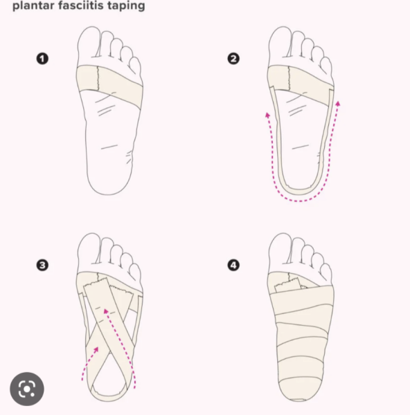 Have you had Plantar Fasciitis?