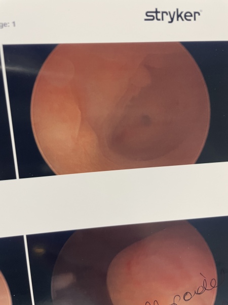 Does anyone know anything about hysteroscopy results images ? Pic attatched here 