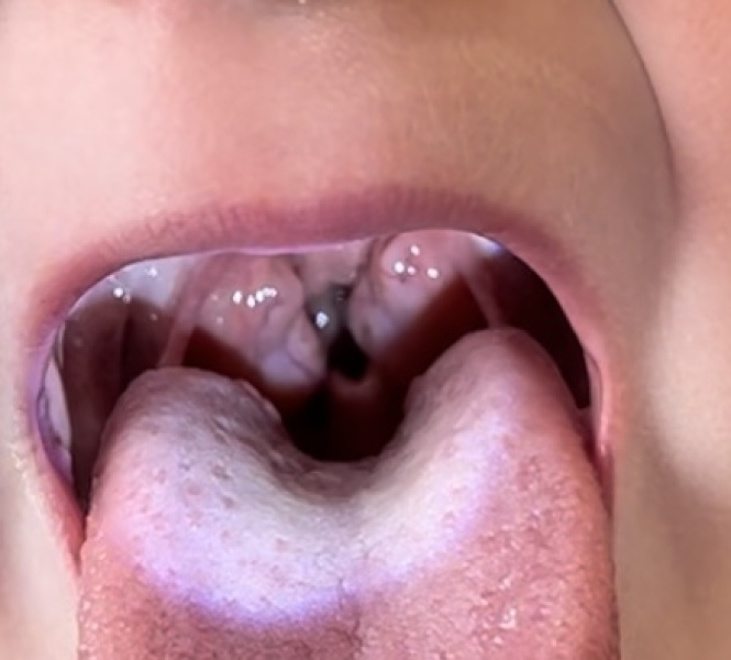 Ginormous tonsils (pic attached) 