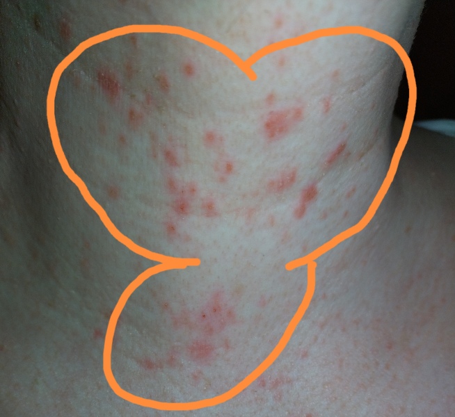 Is this a butterfly rash? /lupus? 
