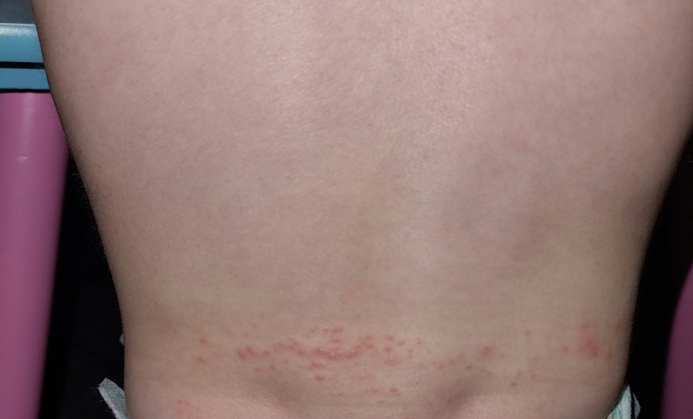 Illness or vaccine side effects?