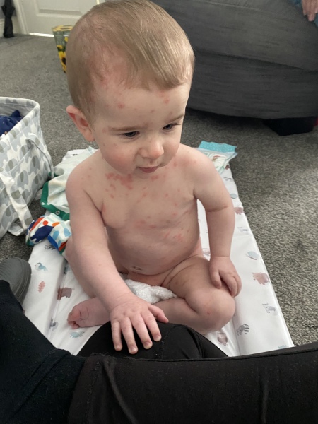 Adult Chickenpox & 6 months old baby