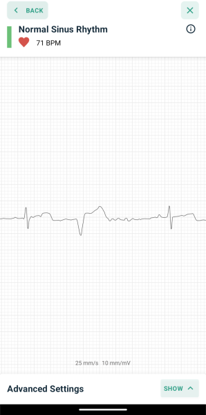 What is my heart doing? Can anyone read ECG? 