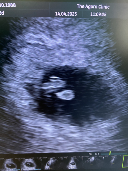 Ivf pregnancy - first trimester