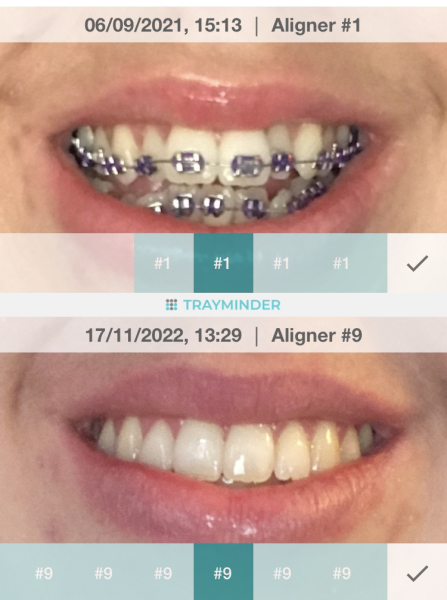 Adult braces