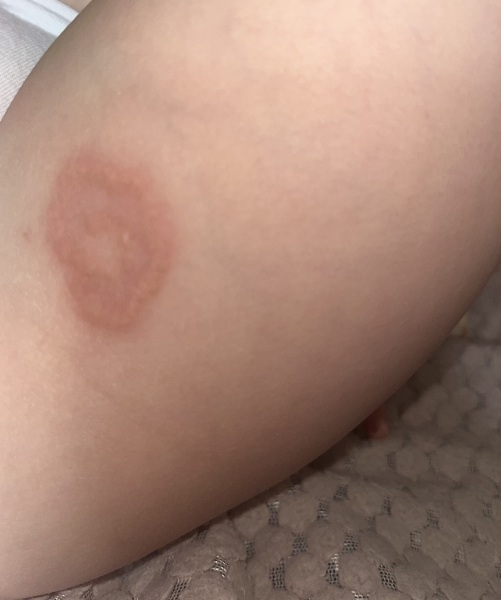 3 year old rash !!!! Help