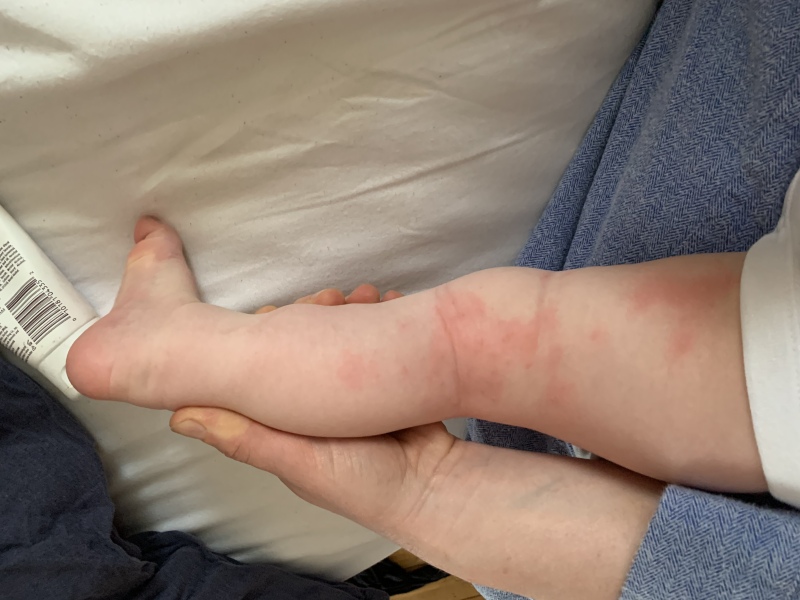 Baby being bitten!!! By what?