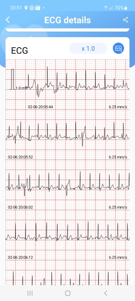 Any nurse/doctors able to interpret ECG?