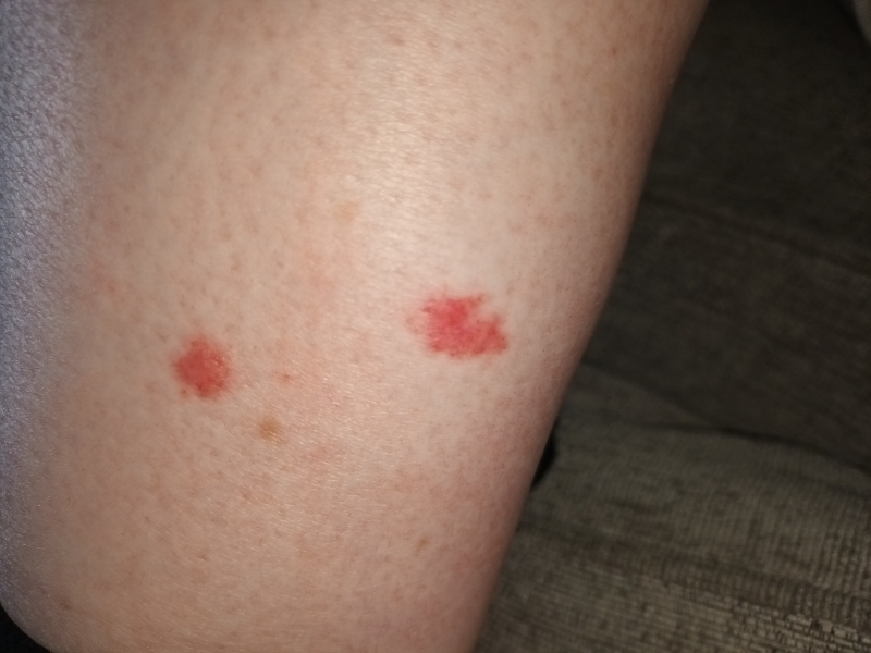 What is biting me? (Photos)