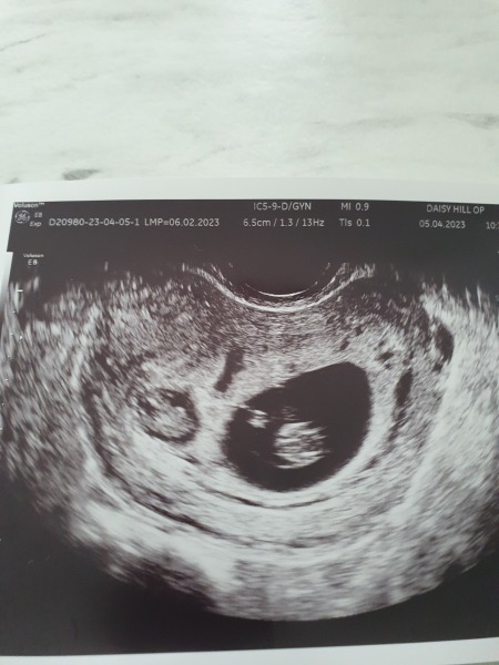 Could second baby be ok?