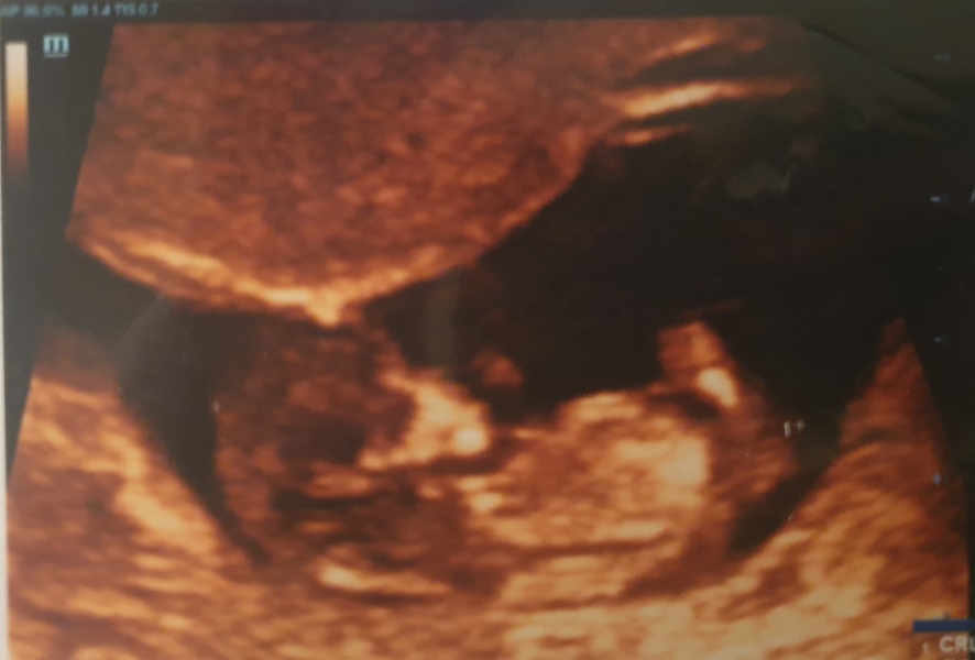 Worried about 12 week scan pictures