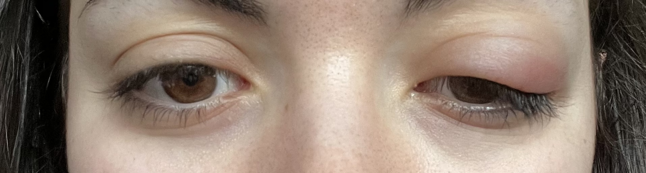 Does this look like an eye infection?