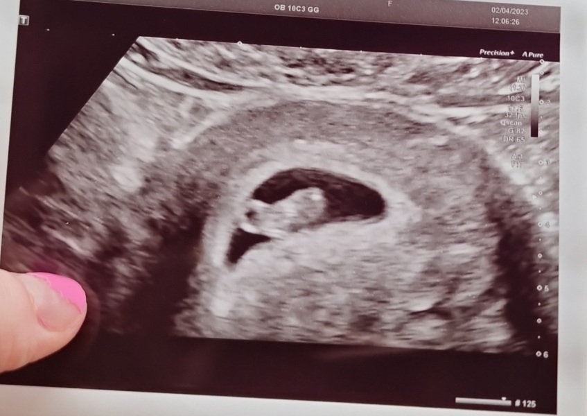 7 Weeks pregnant passing small blood clots
