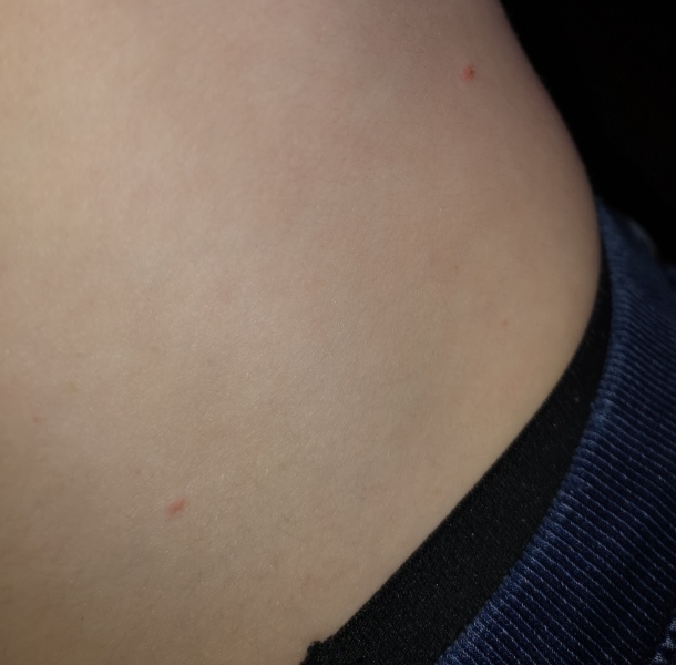 Chicken pox? 