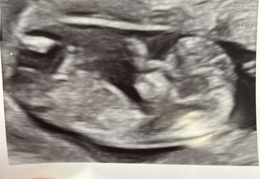 First cycle - IVF / ICSI - Day 4 
