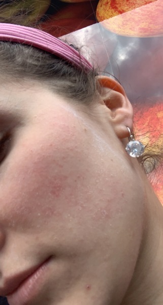 Facial rash…