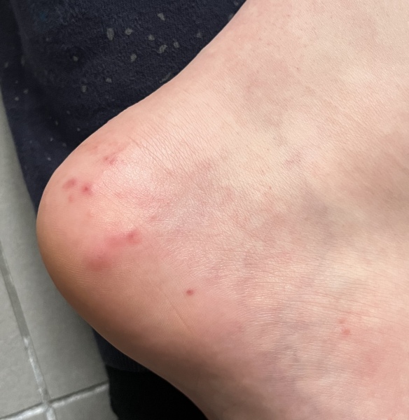 DS’s toe is agony, what can we do? (Includes toe photo)