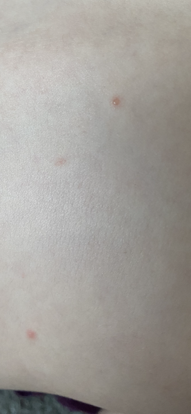 Chickenpox? Picture