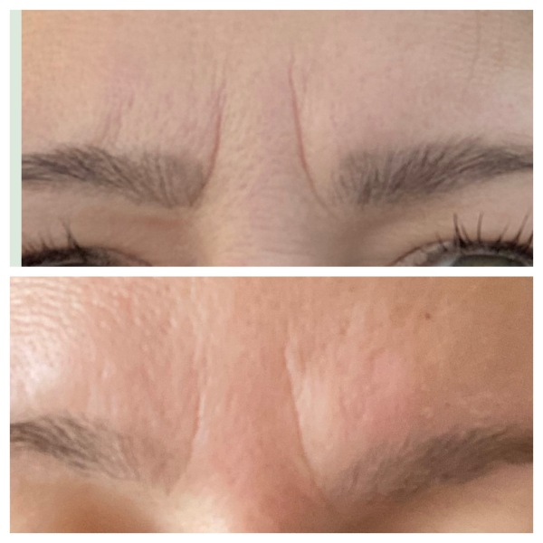 2 huge lines between brows - help