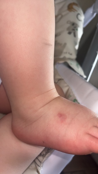 Red mark on DS foot for around 2 weeks