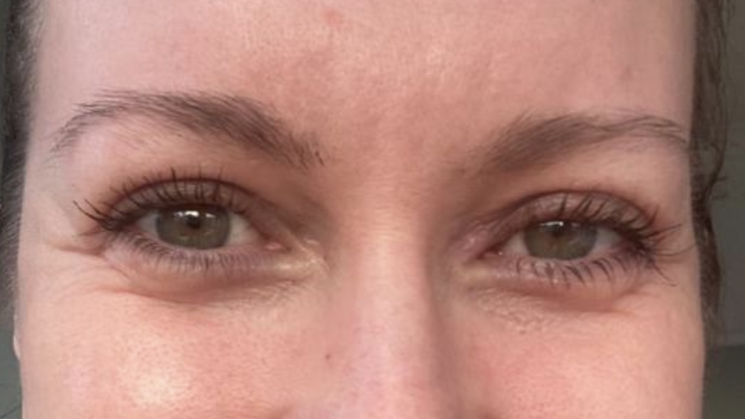 Upper Blepheroplasty