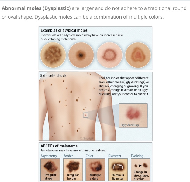 Does DDs mole need to be checked?