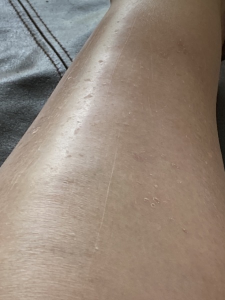 Stucco Keratosis?  Wart growths...photos included