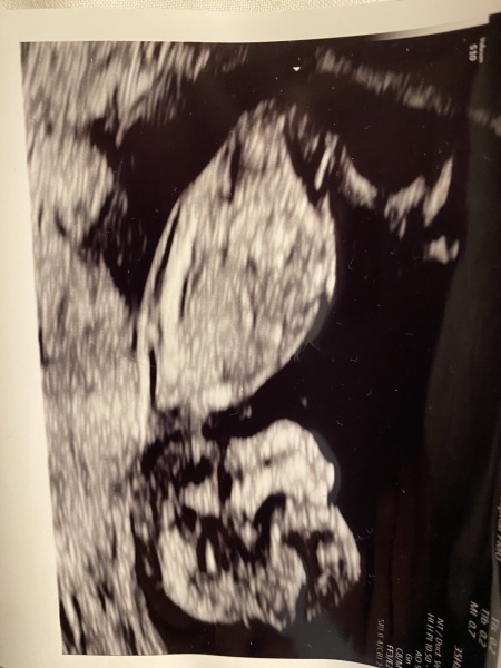 12 week scan, nub/skull guesses?